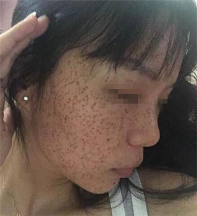 激光祛斑术后恢复过程 皮肤重回白净的诀窍