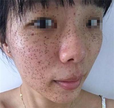 激光祛斑术后恢复过程 皮肤重回白净的诀窍