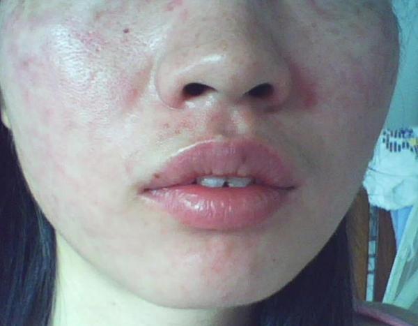 过敏有哪些症状 过敏了怎么办 时尚频道 手机搜狐