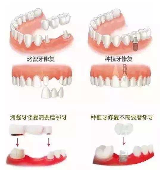 揭秘烤瓷牙那点不为人知的事 健康频道 手机搜狐