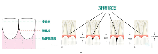 什么是牙齿黑三角?