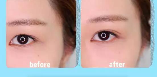 原本的小内双变成自然想新月形外双啦~眼睛也大了很多呢.