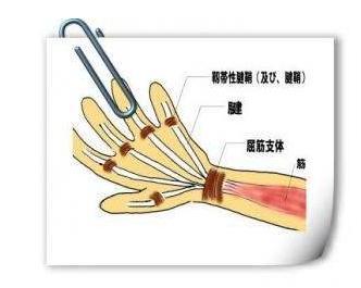 人均腱鞘炎_手腕腱鞘炎图片(3)