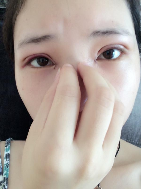 割双眼皮10天,不造为什么我的双眼皮这么自然
