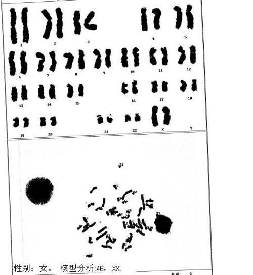 检查,检查结果是:69,xxy/70(71),xxy, n(2n),g显示带320条,三倍体核体