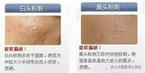 粉刺 粉瘤和痘印 时尚频道 手机搜狐