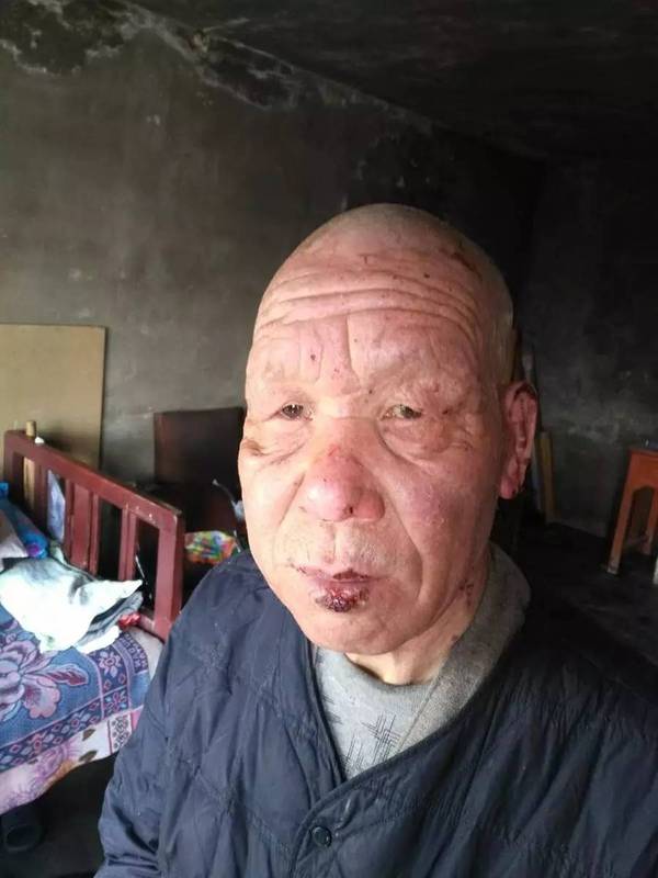 震惊整个朋友圈:寺庙和尚脸部烧伤,雪蜜治疗六天见奇效!