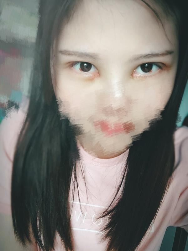 双眼皮术后一个月,好喜欢我现在的眼睛
