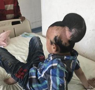 "通常肌肤软组织扩张器的成长程度,要依据所需植皮面积和病人的耐受