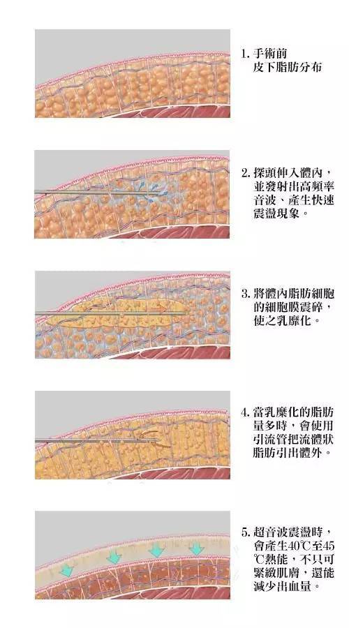 Ultra Z超声波溶脂 雅媛黄金项目 瘦身一次见效 时尚频道 手机搜狐