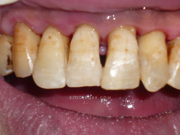 牙周病造成牙龈出血,组织发炎,致病的细菌产生代谢产物都会造成口臭.