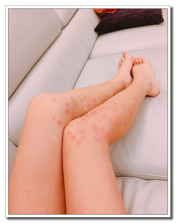 女生穿网袜开心出去玩,腿痒痒的晚上美腿肿成蜂窝