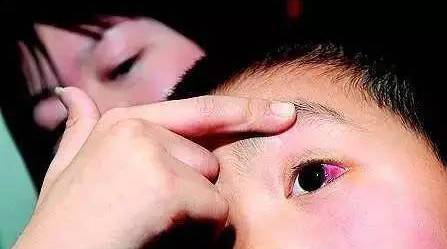 又与健康人握手,而健康人用手揉眼睛时,很可能就会感染上红眼病