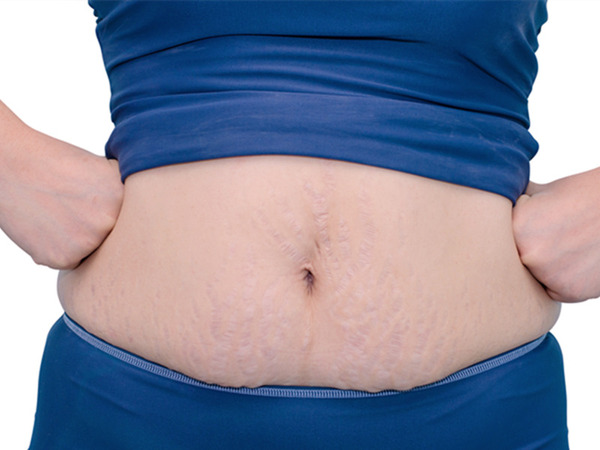 产后这样做,缓解刀口和妊娠纹的"奇痒难忍"!