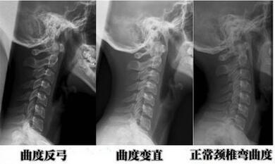 颈椎间盘突出的保守治疗 健康频道 手机搜狐