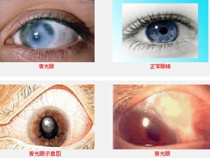 青光眼 青光眼、視神經萎縮 中醫靠這招讓視力0.2回到0.7