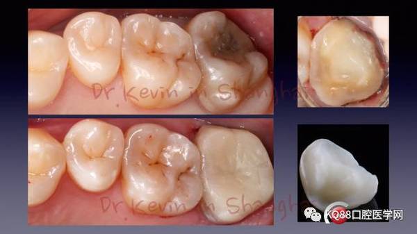 术前检查,根充后牙备,做好的树脂高嵌体及粘接后的照片