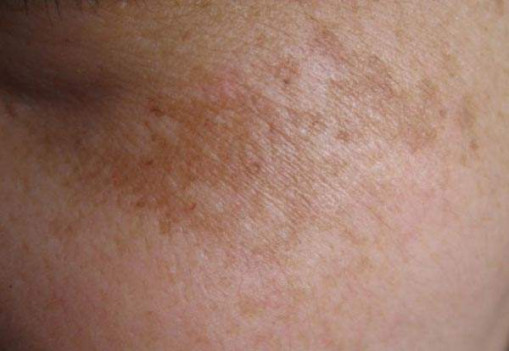 听说黄褐斑是80 女性的公敌 小编为你支招 健康频道 手机搜狐