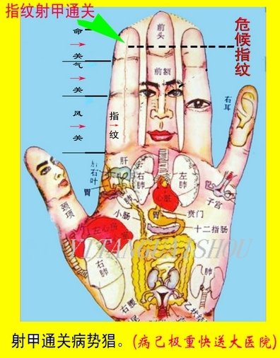 小儿推拿中医辩证之指纹诊断!