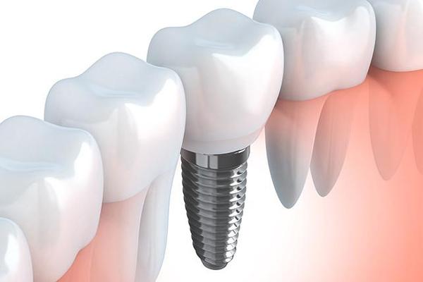 种植牙进入“普惠时代”从价格管控到全方位保障的深层变革 ——