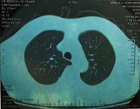体检查出肺结节 离肺癌还有多远 健康频道 手机搜狐 体检查出肺结节 离肺癌还有多远 健康频道 手机搜狐