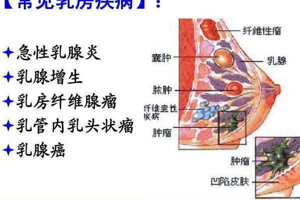 掌握鉴别乳腺囊性增生与乳腺纤维腺瘤的要点 健康频道 手机搜狐