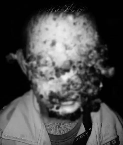 人皮肤蝇蛆病图片图片