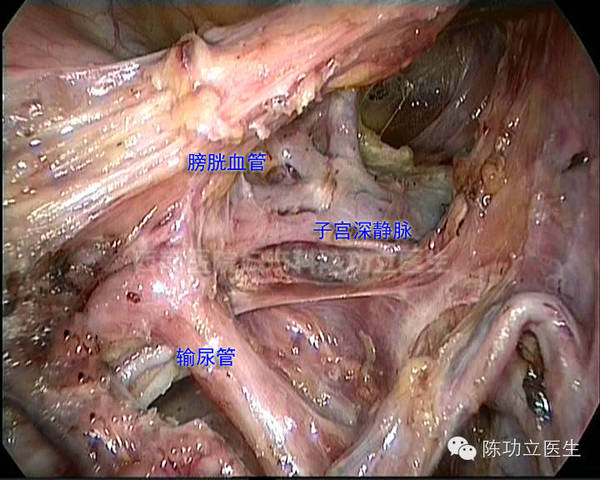 收藏!婦產科手術解剖圖譜之血管解剖