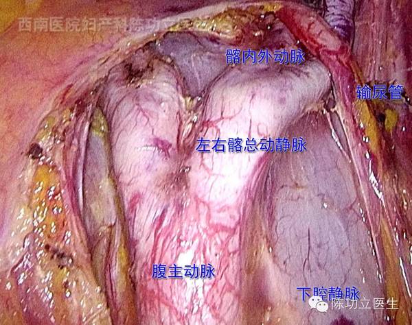 收藏!婦產科手術解剖圖譜之血管解剖