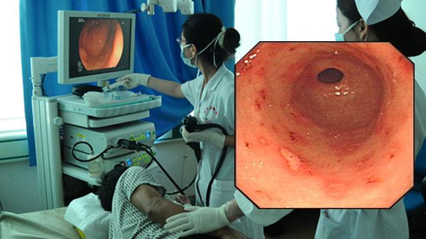 哪些胃病患者需要做胃镜时取活检?