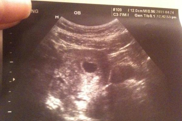 健康宝宝各周胎芽大小参考 快来接好 孕 吧 母婴频道 手机搜狐