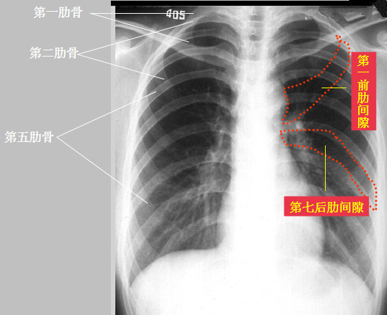 临床医师实践技能 胸片重点解答 教育频道 手机搜狐