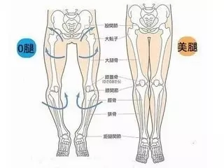 膝内翻 O型腿 的康复矫正 健康频道 手机搜狐