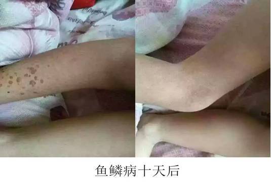 鱼鳞病与毛周角化的治疗方法 健康频道 手机搜狐