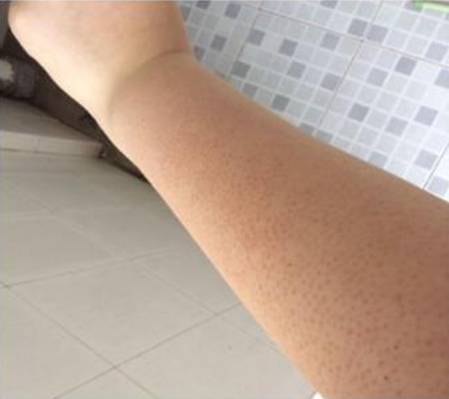 鱼鳞病与毛周角化的治疗方法 健康频道 手机搜狐