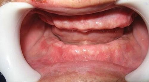 大部分或全口牙齿的牙龈和牙槽骨发生萎缩,但多发生于年轻人