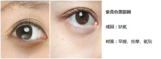 缺氧型黑眼圈 用过去黑眼圈氧贴吗 时尚频道 手机搜狐