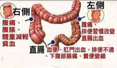 80 大肠癌发现已晚期 哪些症状 暗示 大肠癌 健康频道 手机搜狐