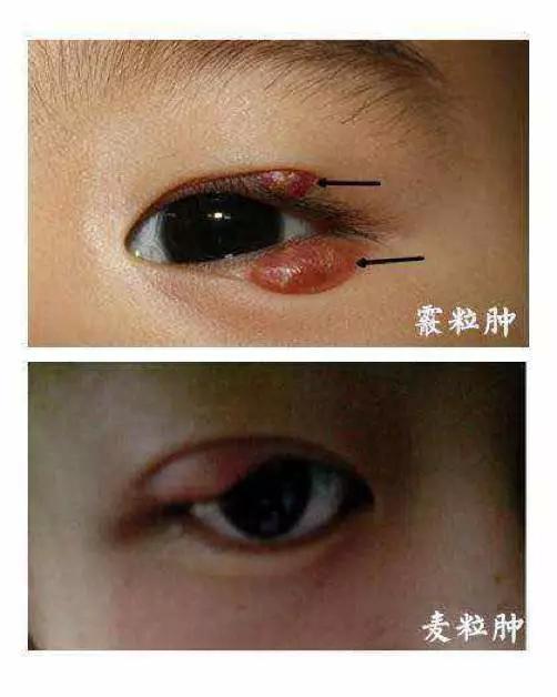 眼睛上的 山丘 霰粒肿还是麦粒肿 别分不清 健康频道 手机搜狐