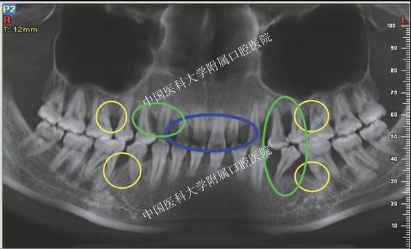 【廣泛型侵襲性牙周炎】牙周聯合正畸治療病例一例