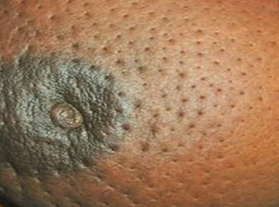 但毛囊处皮肤不会随之水肿,于是容易表面凹陷,就像橘皮一样