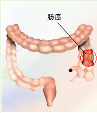 肠癌骨转移有哪些症状 早发现早治疗 健康频道 手机搜狐