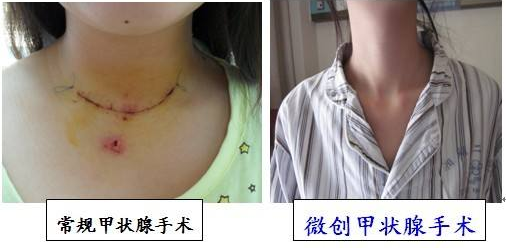 病理剖析 甲状腺结节手术切除危害究竟有多大 健康频道 手机搜狐