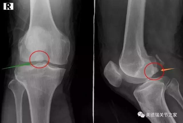膝盖内的游离体一定要取出吗 健康频道 手机搜狐