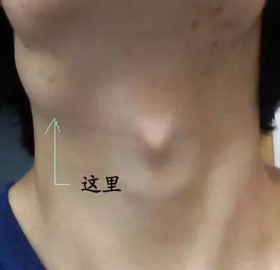 脖子上长小肉粒是怎么回事 千万不要忽视 母婴频道 手机搜狐