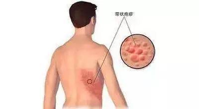皮肤瘙痒起疙瘩 很可能是这些皮肤病哦 健康频道 手机搜狐