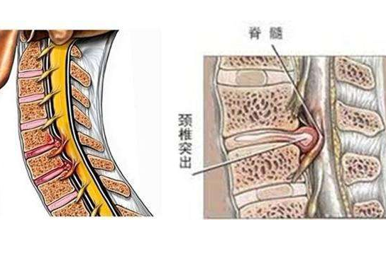 颈椎间盘突出症有这些分类 对症治疗才有效果 健康频道 手机搜狐