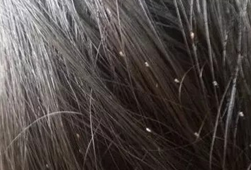 85 的孩子都会长虱子 家长该如何清除与预防它 母婴频道 手机搜狐