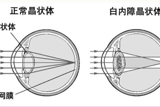 眼睛反映糖尿病病情 这些眼底病变一定不能忽视 健康频道 手机搜狐