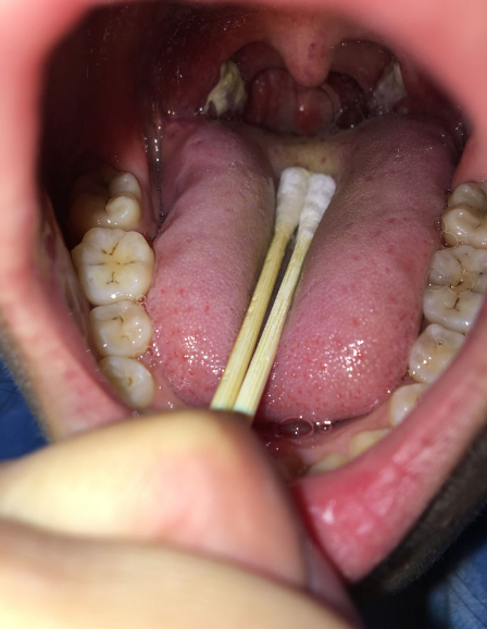 从口中扣出白色结石 奇臭无比 医生称是咽炎 健康频道 手机搜狐 从口中扣出白色结石 奇臭无比 医生称是咽炎 健康频道 手机搜狐